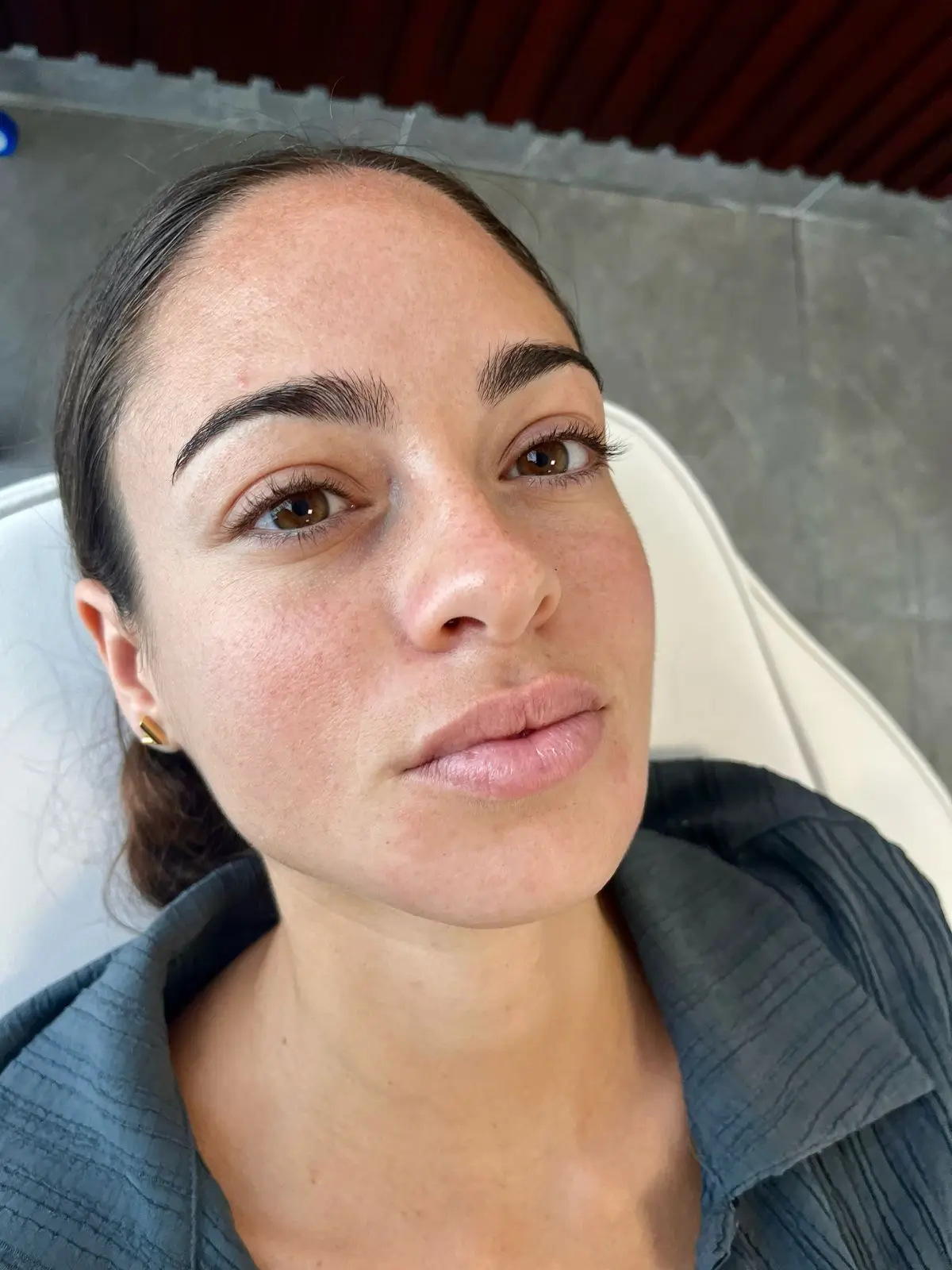 Antes del relleno de labios con ácido hialurónico — Pura Estética Cancún