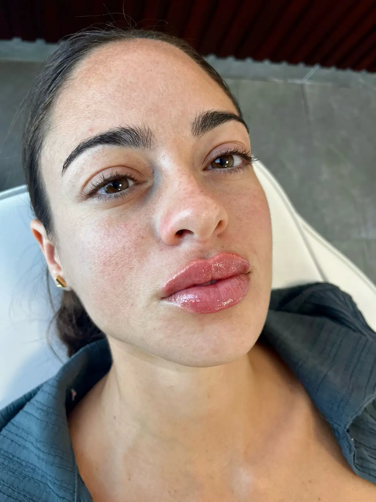 Después del relleno de labios con ácido hialurónico — Pura Estética Cancún