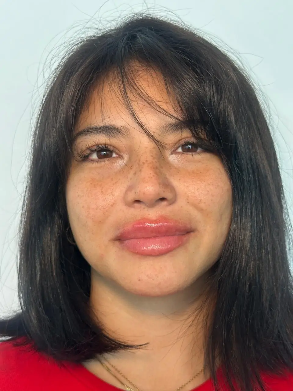 Después — Aumento de labios resultado 2 — Pura Estética Cancún