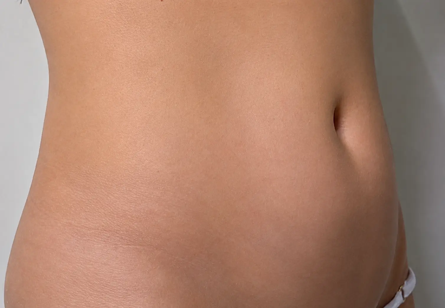 Antes — Hidrolipoescultura — Pura Estética Cancún