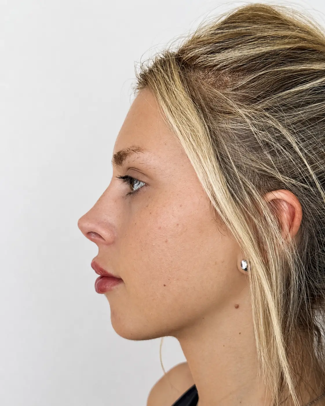 Después — Rinolips — Pura Estética Cancún