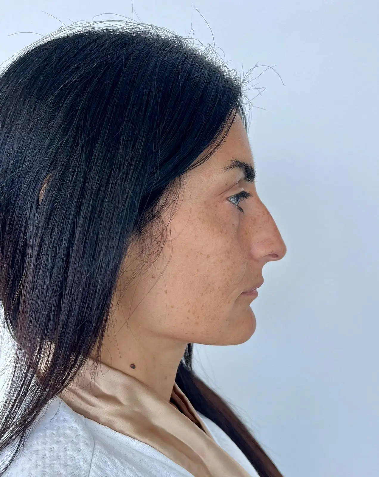 Antes — Rinomodelación resultado 3 — Pura Estética Cancún