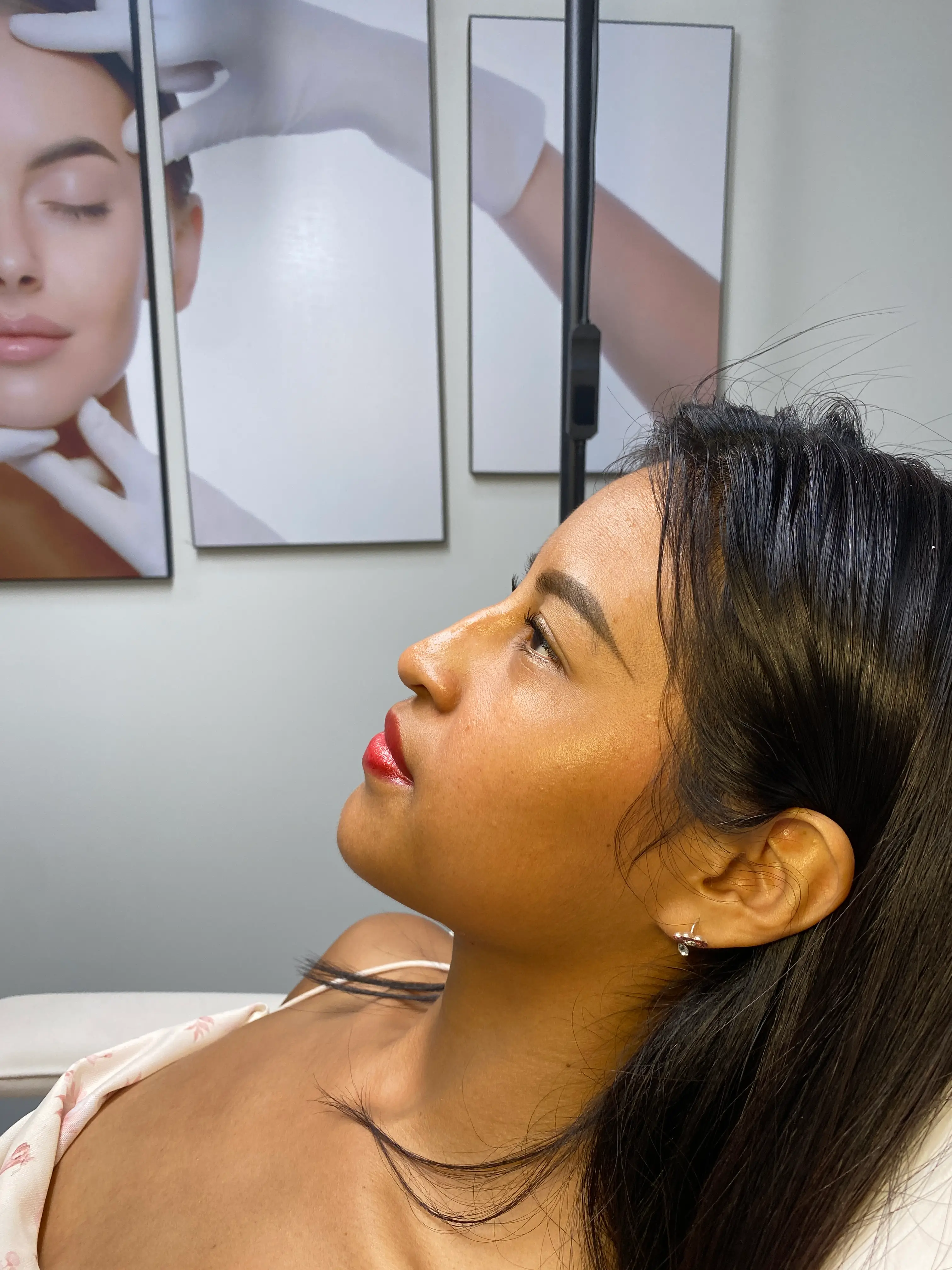 Antes — Rinomodelación resultado 4 — Pura Estética Cancún