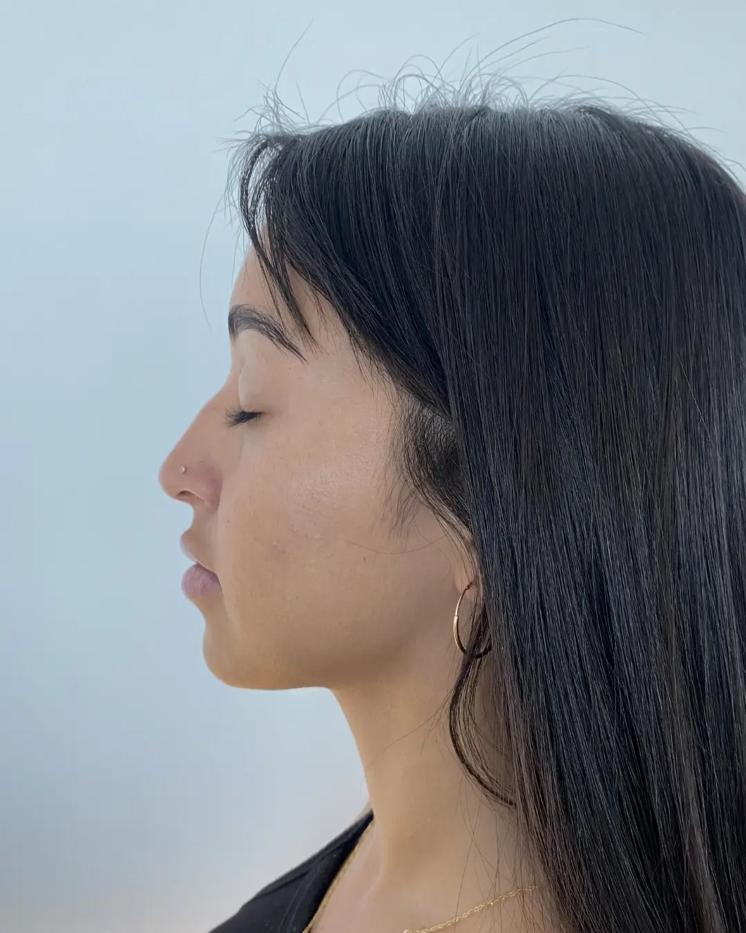 Antes — Rinomodelación — Pura Estética Cancún