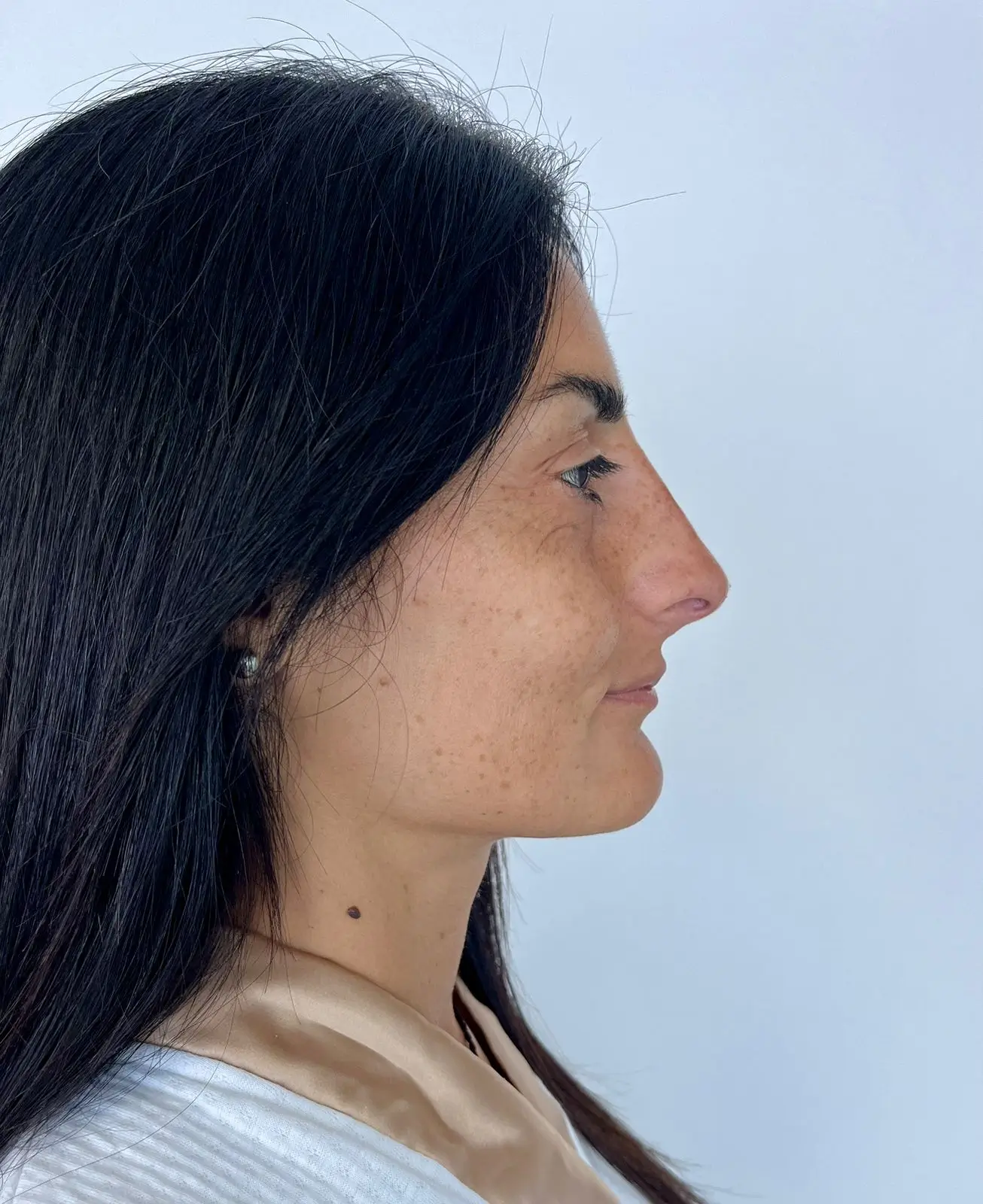 Después — Rinomodelación resultado 3 — Pura Estética Cancún