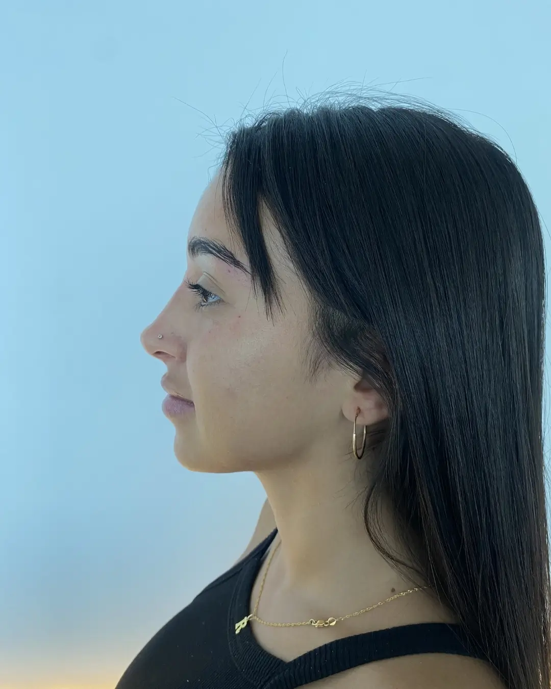 Después — Rinomodelación — Pura Estética Cancún