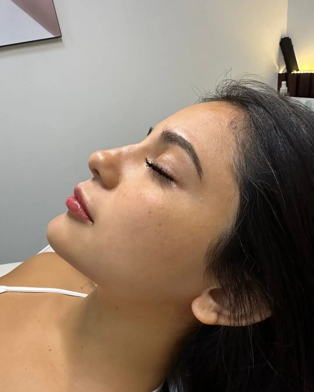 Armonización Facial — Pura Estética
