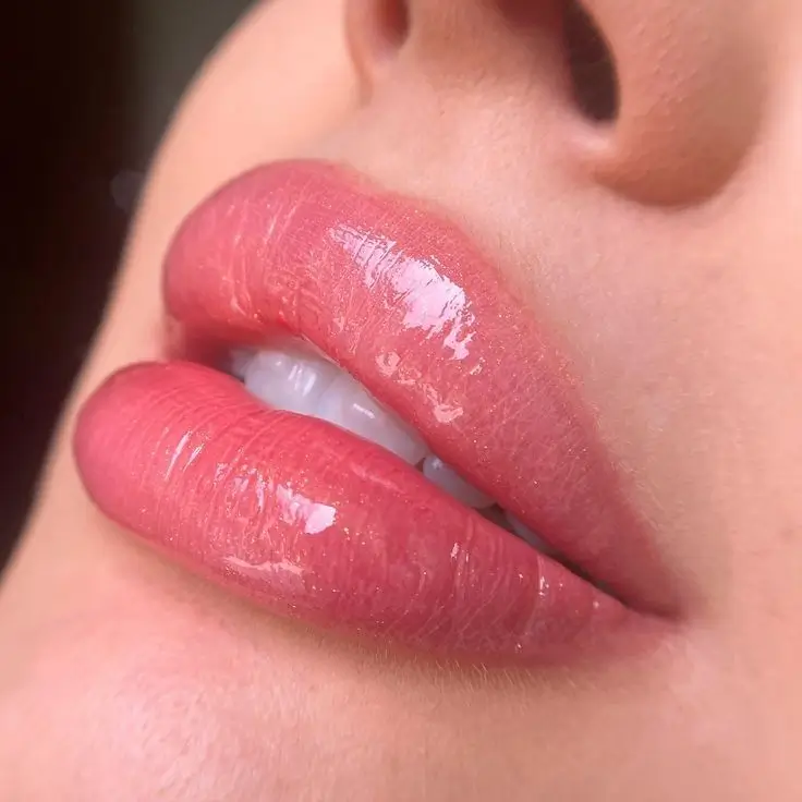 Aumento de labios — Pura Estética