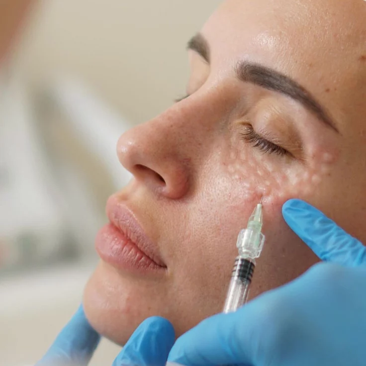 NCTF HA 135 — Pura Estética