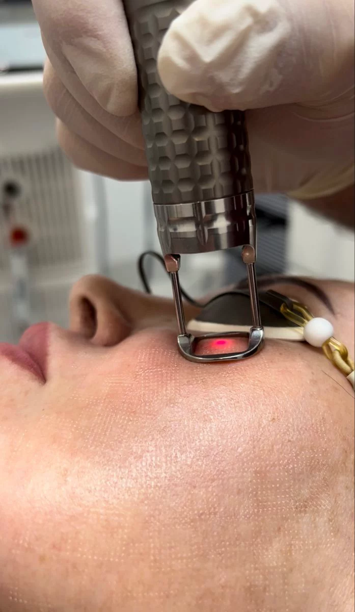 Depilación láser facial en Cancún — Pura Estética